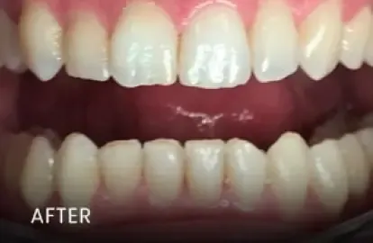 After: brightened upper and lower teeth following whitening in Cedar Park