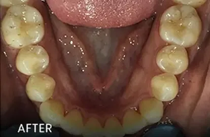 After: aligned upper and lower teeth with improved restorations