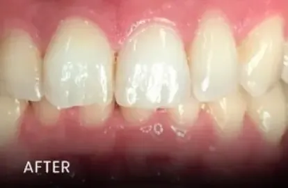 After: whiter front teeth with healthy gums — smile makeover in Cedar Park