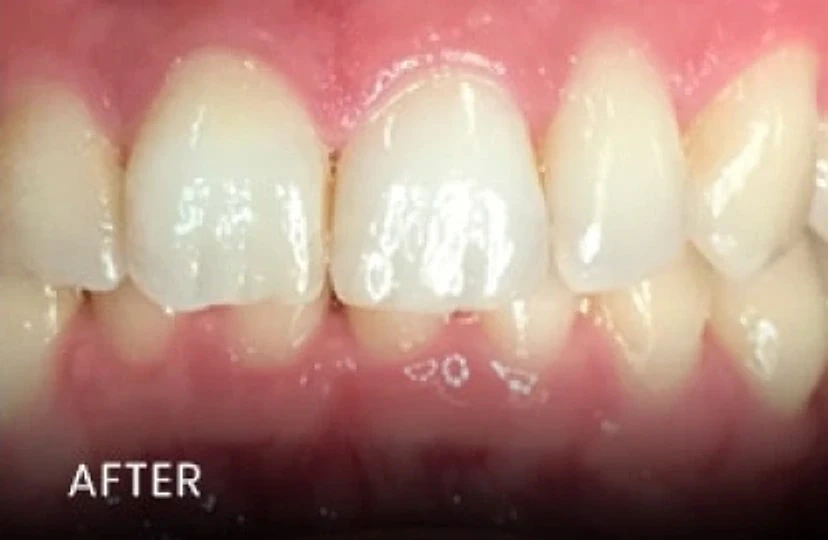 After: whiter front teeth with healthy gums — smile makeover in Cedar Park