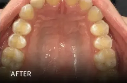 After: properly aligned upper arch with improved spacing — teeth straightening in Cedar Park