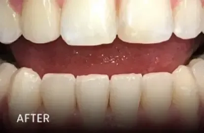 After: brighter, whiter smile with improved alignment