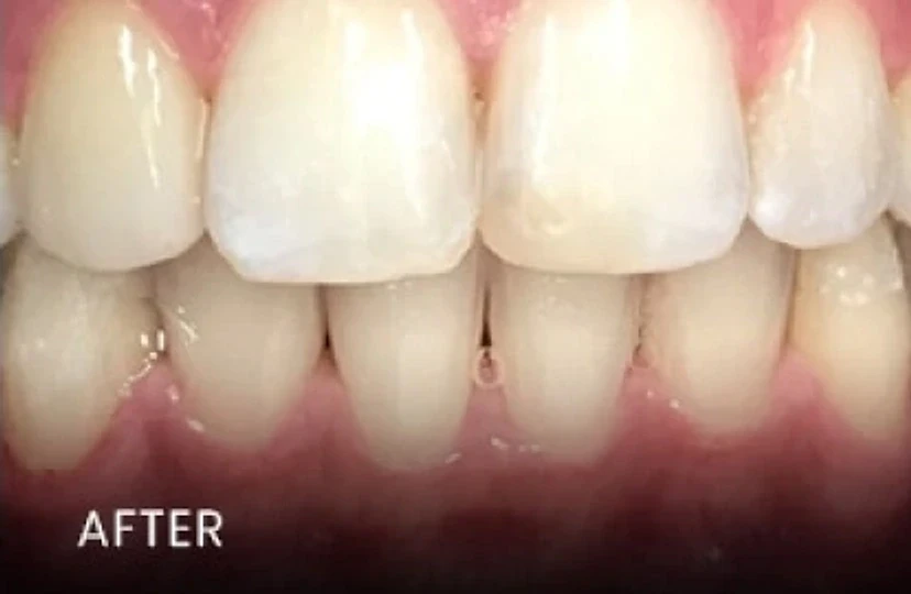 After: brighter, restored front teeth with improved gum health — cosmetic dentistry in Cedar Park