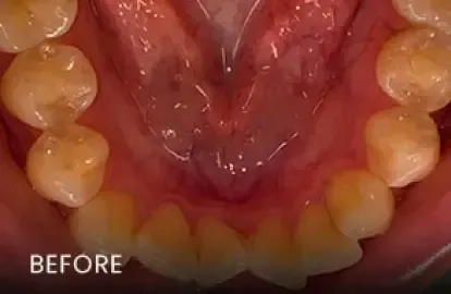 Before: discolored lower teeth with spacing issues