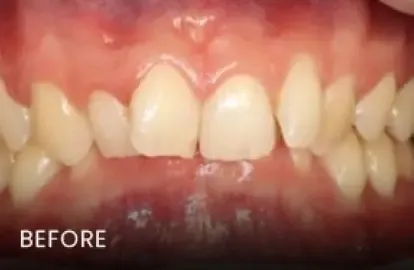 Before: gapped upper front teeth