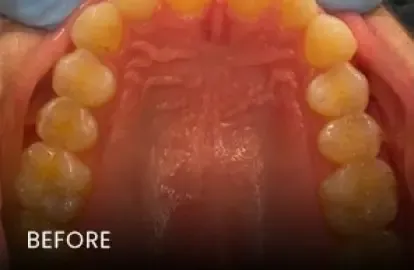Before: crowded, misaligned upper teeth