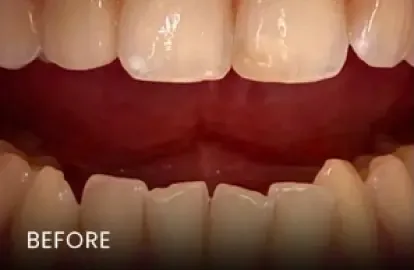 Before: gum recession and uneven smile
