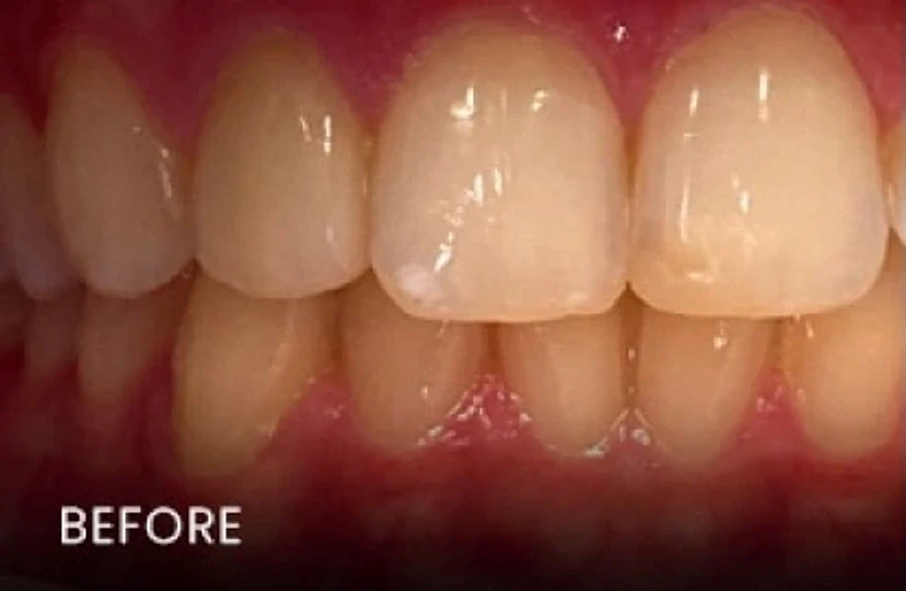 Before: discolored, stained upper front teeth