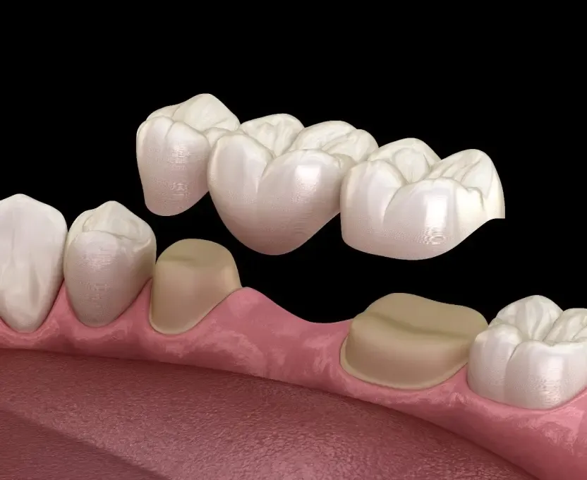 Porcelain crowns and bridge restoring missing teeth