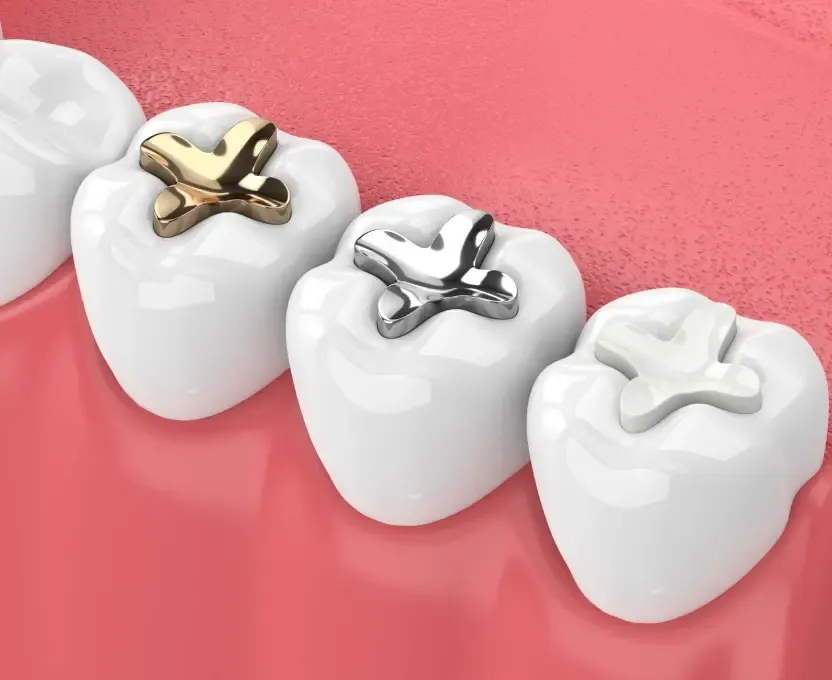 Illustration comparing gold, silver and tooth-colored composite dental fillings