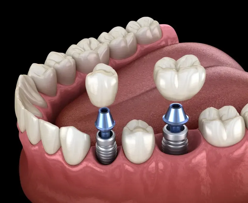 Illustration of dental implants with titanium posts and porcelain crowns